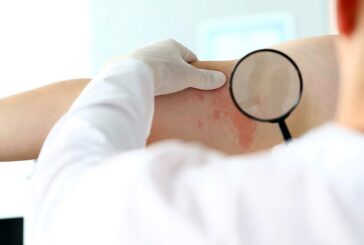 В Беларуси доступны различные подходы к лечению псориаза